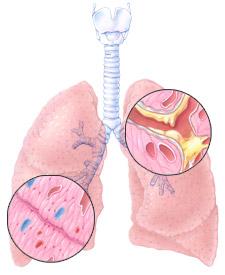 airways and excessive production of mucus that results in a chronic
