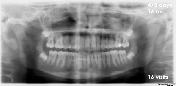resorption noted or impaction of 3rd molars