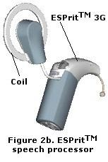 A cochlear implant system consists of two main parts: an internal implanted part called the implant, and an external part known as the speech processor. How a cochlear implant works 1.