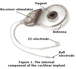 These pulses are sent to the coil and are then transmitted across the intact skin (by radio waves) to the implant. 4. The implant sends a pattern of electrical pulses to the electrodes in the cochlea.