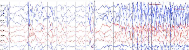 Ictal EEG Question 1. Infantile spasms are most commonly caused by a. Inborn errors of metabolism b. Structural brain abnormalities c.