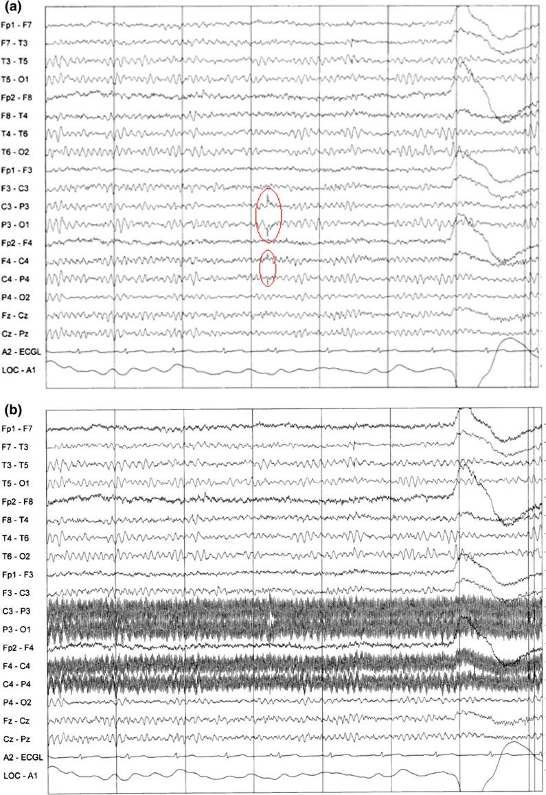 26 K. Tufenkjian Fig. 2.15 a Electrode pop artifact. Poor contact at the P3 and C4 electrodes resulted in an isolated potential at these two contacts (60-Hz notch filter on).