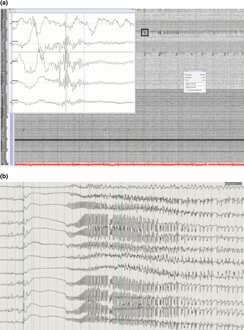 2 EEG Instrumentation, Montage, Polarity, and Localization 23