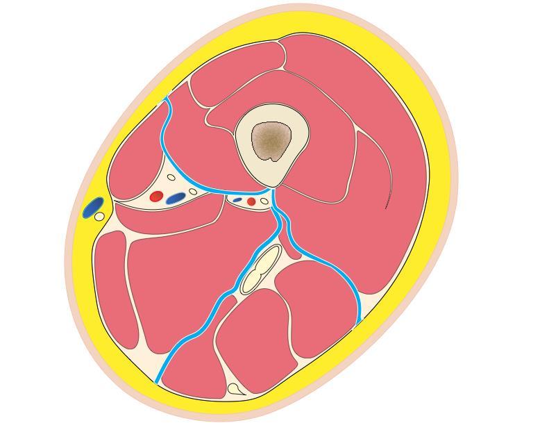 Subsite-Specific Complications Femoral vessels