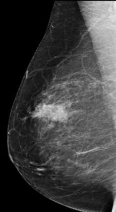 outer of the right breast associated with multiple intralesional pleomorphic calcifications causing