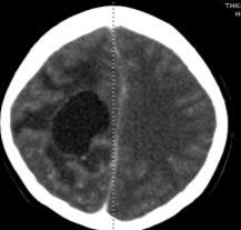 peripheral enhancing rim and enhancing nodule at right corticomedullary junction of