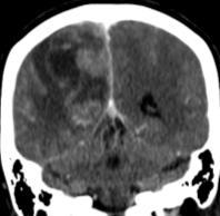 MRI finding CT & MRI Brain -Enhancing mass at right parieto-occipital region with