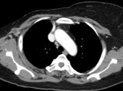 Pneumonitis at right middle lobe or chronic