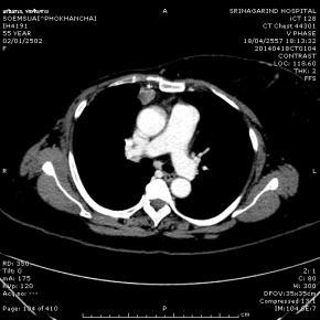 abdomen CT  