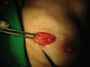 Surgery Breast Mastectomy ( skin sparing, nipple sparing