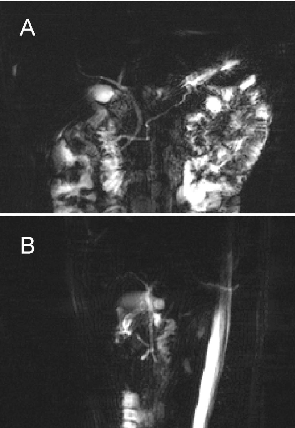 532 C. K. Sun, J. H. Chen, K. C. Yang, and C. C. Wu papilla (dorsal duct). The clinical relevance of remains controversial.