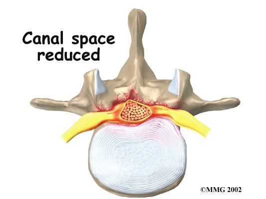 shrinks to 12 millimeters or less. When the size drops below 10 millimeters, severe symptoms of lumbar spinal stenosis occur.