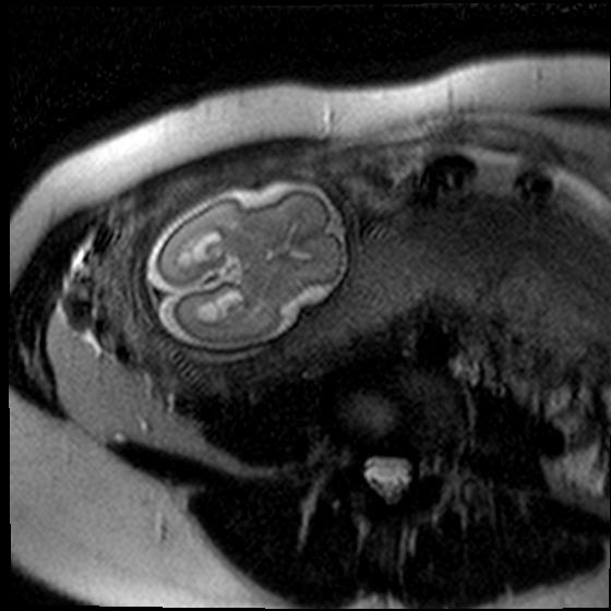 5 * * A B A) Fetal MRI at 26 weeks of gestation (axial T2 haste weighted sequence):