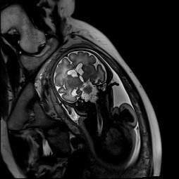 heads); B) Fetal MRI at 36 weeks of gestation (coronal T2 haste weighted sequence):
