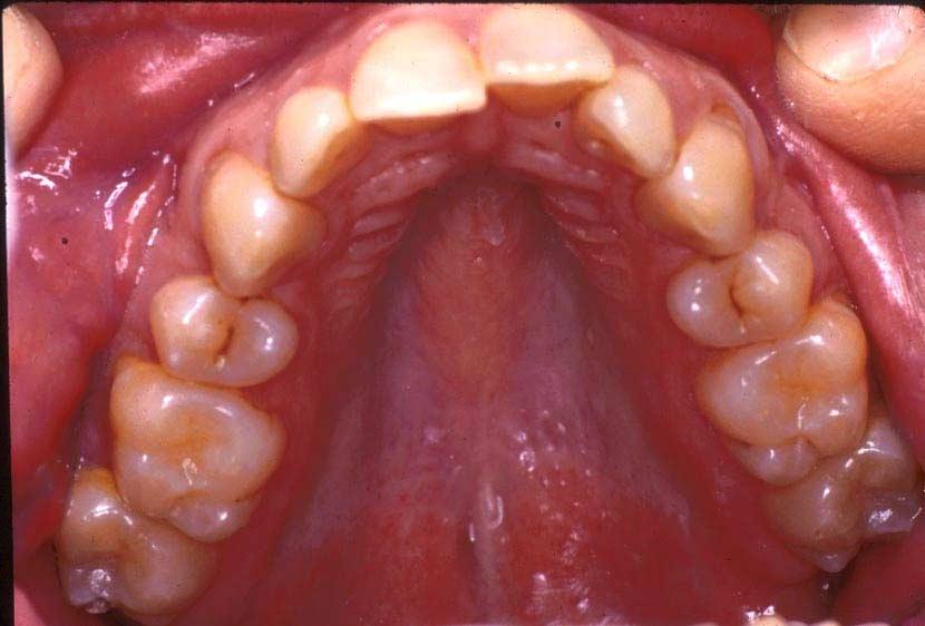 D53 Do not take out bicuspids for orthodontic