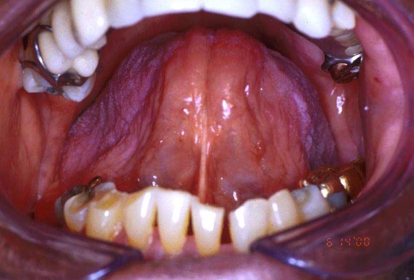 D64 Inherited ankyloglossia is a
