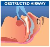 CPAP Treatment From 1985 To 2011 CPAP is indicated for the
