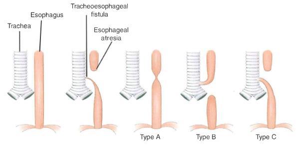 Congenital anomalies of trachea 1.