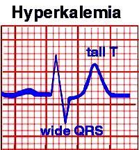 Hyperkalemia & ECG Tall, peaked T s Wide