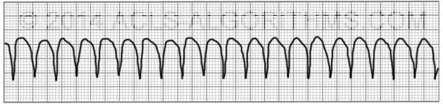 Indications Pulseless ventricular tachycardia (VT)