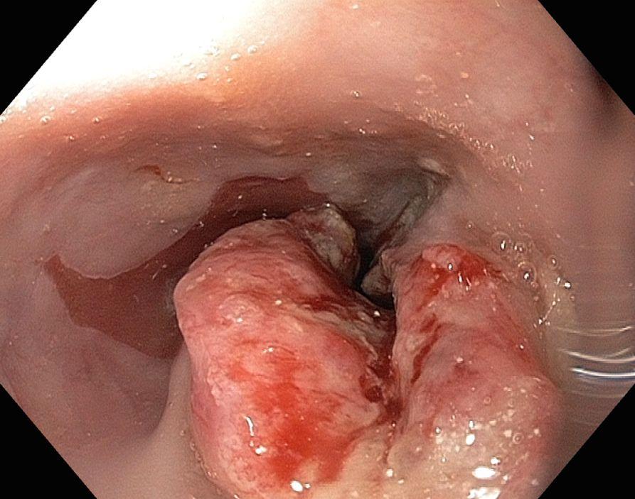 in patients with Barrett s esophagus.