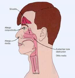Related Anatomic Structures Compromised by Allergic Rhinitis Allergic Rhinitis What is Allergic Rhinitis?