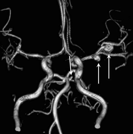 SAH, H & H = 1, GCS = 15, Fisher CT = 1, cerebral angiography 4 vessels: 1) saccular MCA right aneurysm Ø max = 4, 95 mm and neck = 6,94 mm 2) ophthalmic right artery microaneurysm, 3) internal