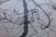 06) Primary outcome mrs 0 2 no longer significant Endovascular 83%