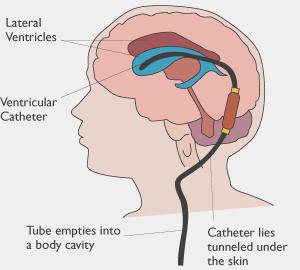 Hydrocephalus: Occasionally epileptic fits may occur, but these can be controlled with medication.