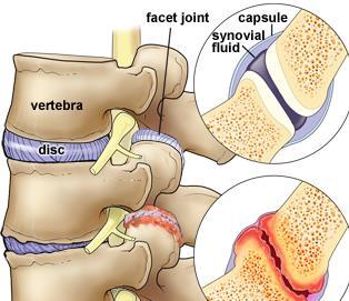 Medication, physical therapy, joint injections, nerve blocks, and nerve ablations may be used to manage symptoms. Chronic symptoms may require surgery to fuse the joint.