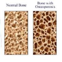 1) bone growth Appositional interstitial Bone Growth