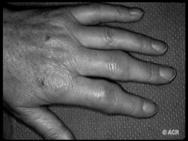 Clinical Manifestations of Rheumatoid Arthritis (1) Arthritis (a)