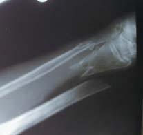 Injuries to Skeletal System Can involve joints &/or bones May be