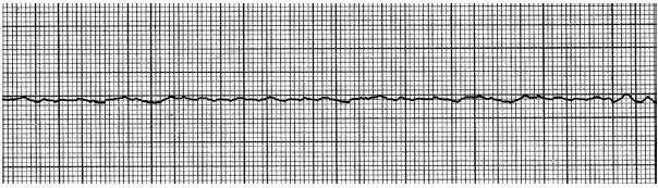 : QUESTION 28 A 60-year-old patient complains of chest pain for 60 minutes. The patient is cool and clammy, heart rate is 40 beats/min, and blood pressure is 70/50 mm Hg.