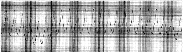 /Reference: : QUESTION 30 A patient with a myocardial infarction develops the following rhythm and loses consciousness. The patient is pulseless and not breathing.