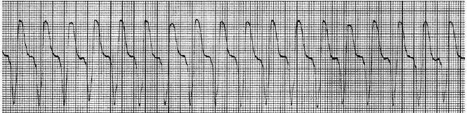 /Reference: QUESTION 143 A patient complains of shortness of breath and chest pain radiating to the neck. Blood pressure is 80/50 mm Hg and the respiratory rate is 40 per minute.
