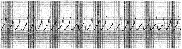 An 80-year-old complains of chest pain that began 1 hour ago. The patient is pale and diaphoretic. BP is 80/50 and respiratory rate is 24. The monitor shows the following rhythm.