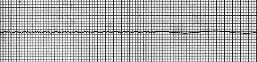 QUESTION 165 The patient has been in the following rhythm for 2 3 minutes. Treatment? Correct Answer: CPR, epinephrine, atropine, consider transcutaneous pacemaker. (The rhythm above shows asystole.