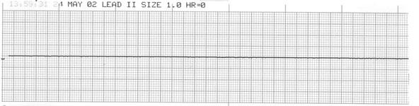 Ventricular rate not shown/visible. PQRST Information: P wave often present, QRS complex absent, and no T wave visiable.
