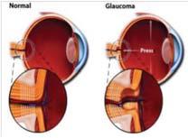 Väčšinou je glaukómový výskum venovaný otázkam diagnostiky a liečby včasných foriem glaukómu napríklad diagnostika skorých štrukturálnych zmien, ktorá využíva spektrálnu optickú koherentnú tomografiu