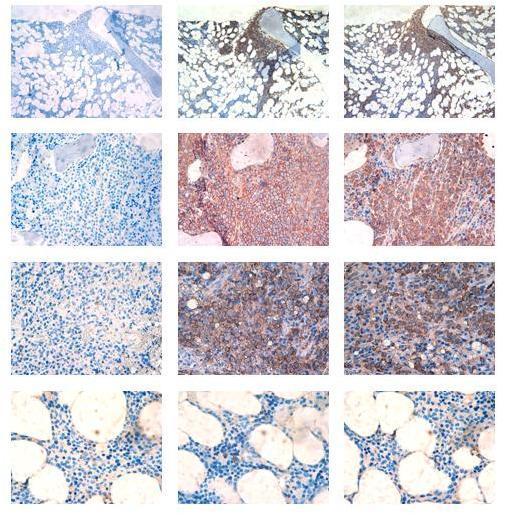 Preclinical Data Multiple Myelma Patient tissue surced frm 11 patients at primary diagnsis, 9 with relapsed disease and 4 healthy cntrls MM1 Istype Cntrl CD138 PAT-SM6