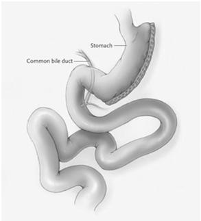 JAMA 2015 Bypass Evolution of Surgery Bariatric surgery for