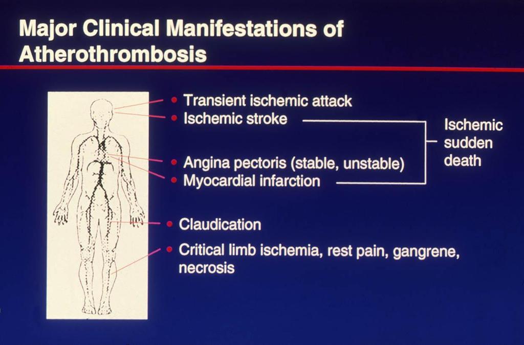 Atherosclerosis-systemic disease Atherosclerosis is considered a systemic disease, therefore subjects