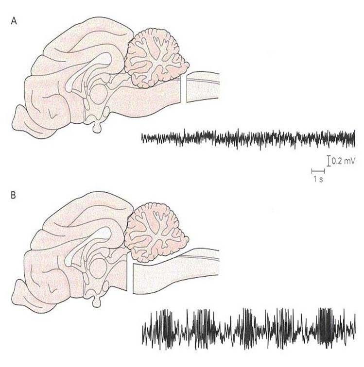 EEG effects of brainstem transsections (Bremer 1935-37) ENCEPHALE