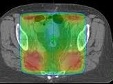 Shaping of Radiation Lowers Complications