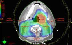 Cancers impacted: Prostate Ca Rectal Ca Anal Ca