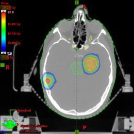 INTELLIGENT TREATMENT DELIVERY: High Definition Radiosurgery Brain Stem Brain Stem