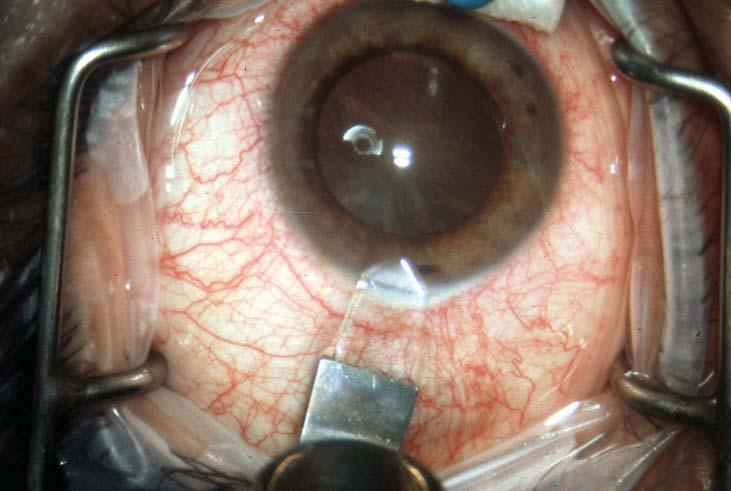 Acute-Onset Endophthalmitis Following Cataract Surgery Clear cornea phacoemulsification 7 of