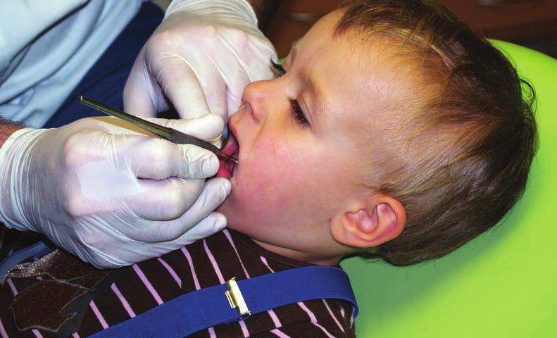 Most frequent oral diseases in early childhood Babies can get tooth decay and gingivitis; this is usually associated with poor oral hygiene, often when there is a lack of brushing before sleeping