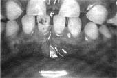 is a 2 1/2 year old female with severe Class III malocclusion (Fig 3) that was observed at age 2 years.